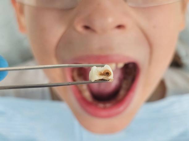 Best Emergency Dentist for Knocked-Out Tooth in Piermont, NY